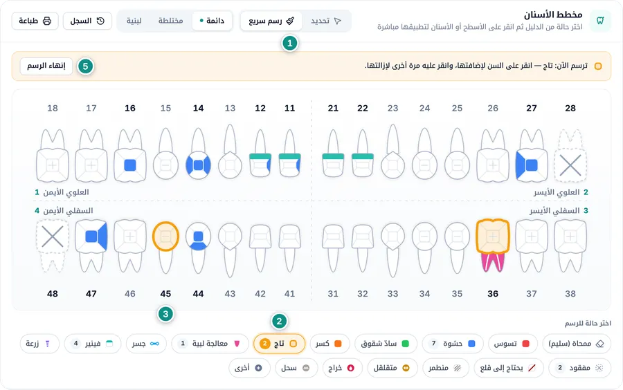 الرسم السريع: حشوة على السن 47 وتاج على السن 45، وشريط «ترسم الآن: تاج» فوق المخطط