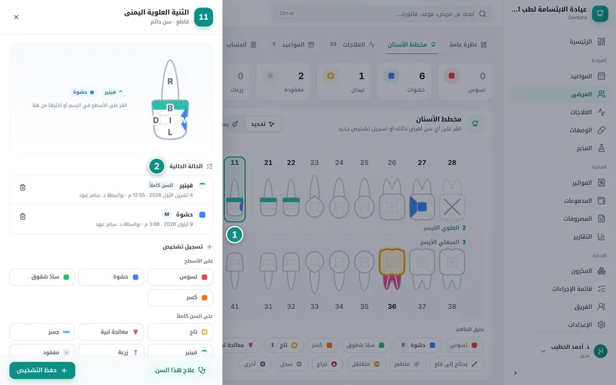 لوحة السن 11 مفتوحة بجانب المخطط: رسم السن وحالته الحالية (فينير وحشوة)