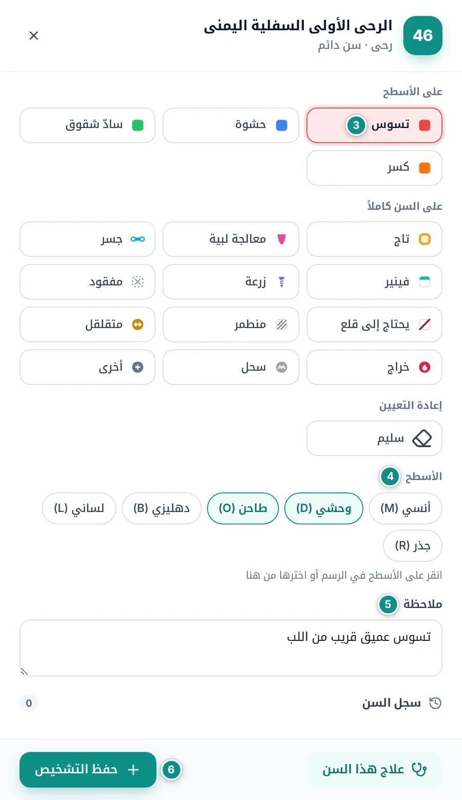 تسجيل تسوس على السطحين O وD من السن 46 مع ملاحظة، قبل النقر على حفظ التشخيص